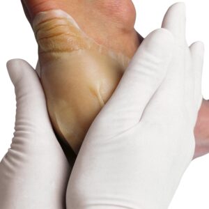 Hydrocoll (Similar to Granuflex) Hydrocolloid Dressing 10cm x 10cm (Singles)